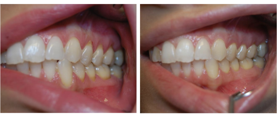 Điều trị mô nha chu người