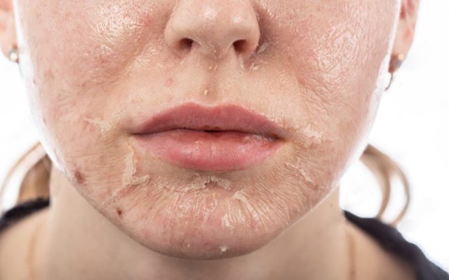 Lạm dụng treatment và hoạt chất mạnh